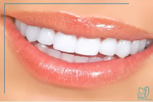 لمینت دندان اصفهان