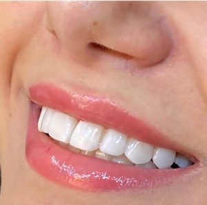 نمونه کار زیبایی دکتر میترا آداودی دندانپزشک زیبایی