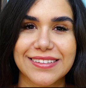 نمونه کار زیبایی دکتر میترا آداودی دندانپزشک زیبایی