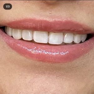 دکتر میترا آداودی | نمونه کار کامپوزیت و لمینت | اصفهان