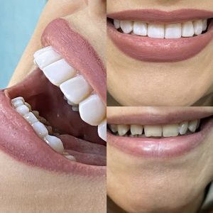 دکتر میترا آداودی | نمونه کار کامپوزیت و لمینت | اصفهان