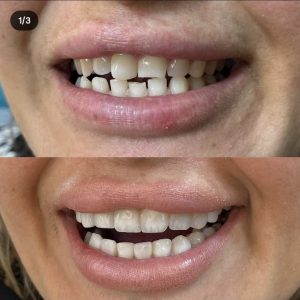 دکتر میترا آداودی | نمونه کار کامپوزیت و لمینت | اصفهان