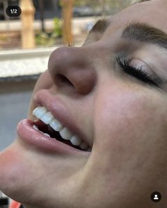 نمونه کار زیبایی دکتر میترا آداودی دندانپزشک زیبایی