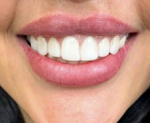 دکتر میترا آداودی | نمونه کار کامپوزیت و لمینت | اصفهان