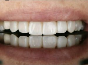 دکتر میترا آداودی | نمونه کار کامپوزیت و لمینت | اصفهان