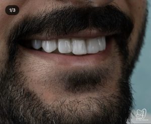 دکتر میترا آداودی | نمونه کار کامپوزیت و لمینت | اصفهان