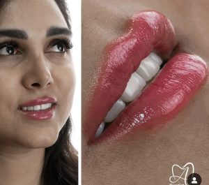 نمونه کار زیبایی دکتر میترا آداودی دندانپزشک زیبایی