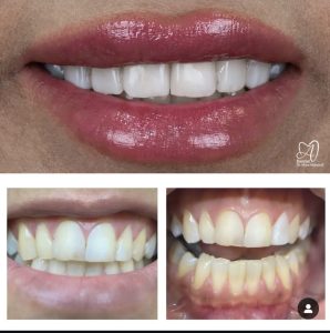 دکتر میترا آداودی | نمونه کار کامپوزیت و لمینت | اصفهان