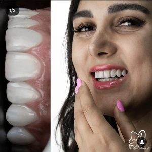 نمونه کار زیبایی دکتر میترا آداودی دندانپزشک زیبایی
