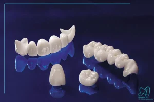 پروتز ثابت دندان اصفهان