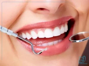 مزایا و معایب بلیچینگ دندان