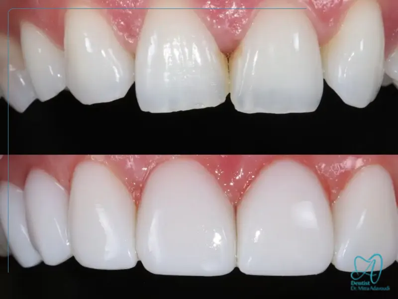 کدام رنگ‌ها پس از کامپوزیت ممنوع‌اند