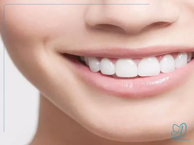 طرح لبخند برای دندان‌های لب‌پردار یا کج