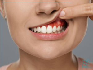 درمان آبسه دندان در خانه و کلینیک