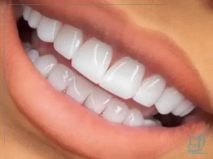 آیا کامپوزیت دندان باعث لکه میشود؟