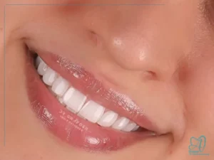هزینه کامپوزیت دندان چقدر است؟