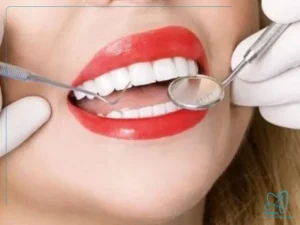 چگونه جلوی زرد شدن دندان لمینتشده را بگیریم