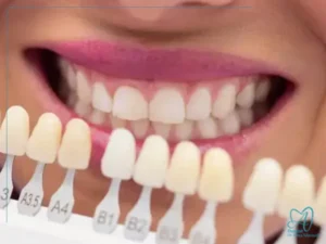 لمینت دندان چیست و چگونه انجام میشود؟