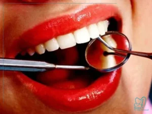 هزینه‌های جانبی در لمینت دندان چیست