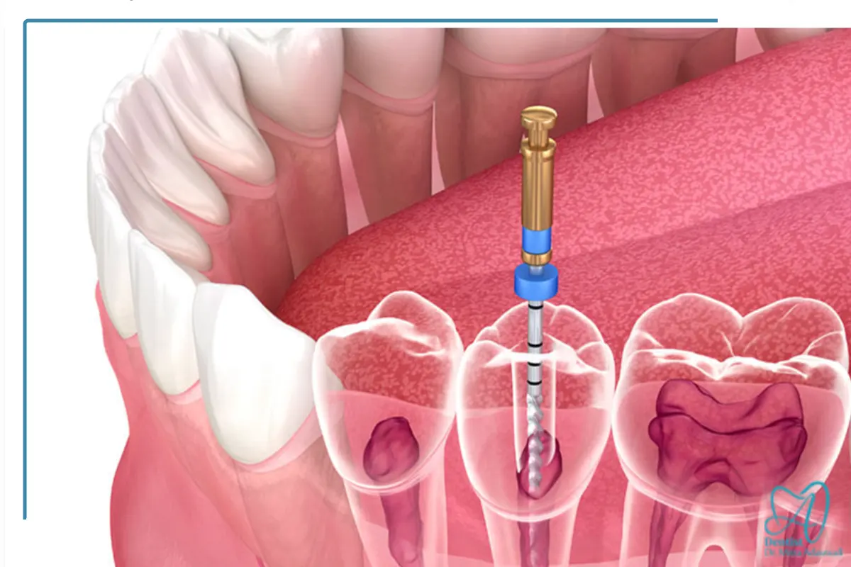 درمان ریشه و عصب کشی دندان اصفهان