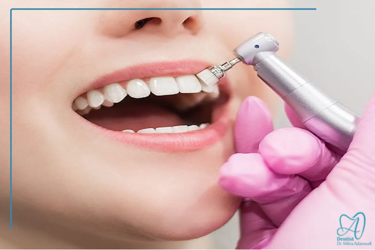 جرمگیری وبروساژ دندان اصفهان