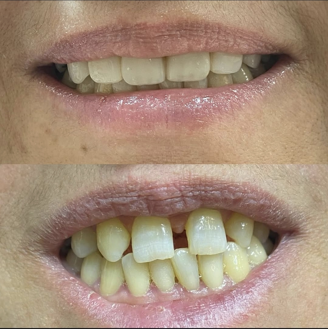 دکتر میترا آداودی | نمونه کار کامپوزیت و لمینت | اصفهان