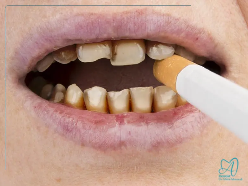 تاثیر سیگار و قهوه بر بلیچینگ و لمینت