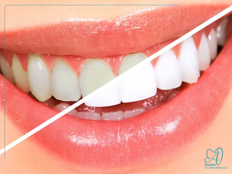 عوارض احتمالی بلیچینگ دندان