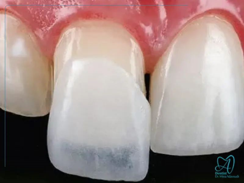 کامپوزیت دندان برای دندان‌های حساس