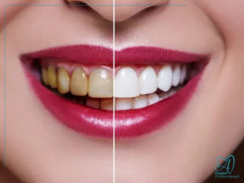 مراقبت خانگی بعد از بلیچینگ دندان