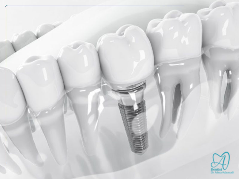 کاشت ایمپلنت بدون جراحی