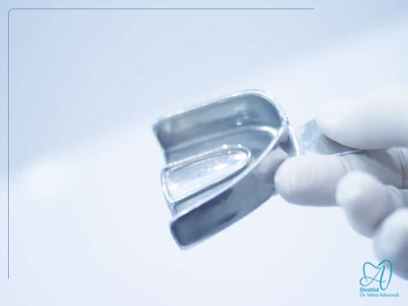 مراحل قالب گیری برای ارتودنسی