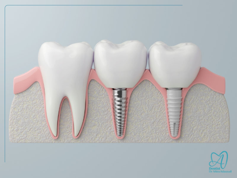ایمپلنت تیتانیومی و زیرکونیا
