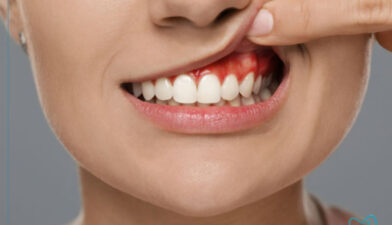 درمان آبسه دندان در خانه و کلینیک