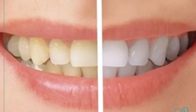 اثرات بلیچینگ روی حساسیت دندان
