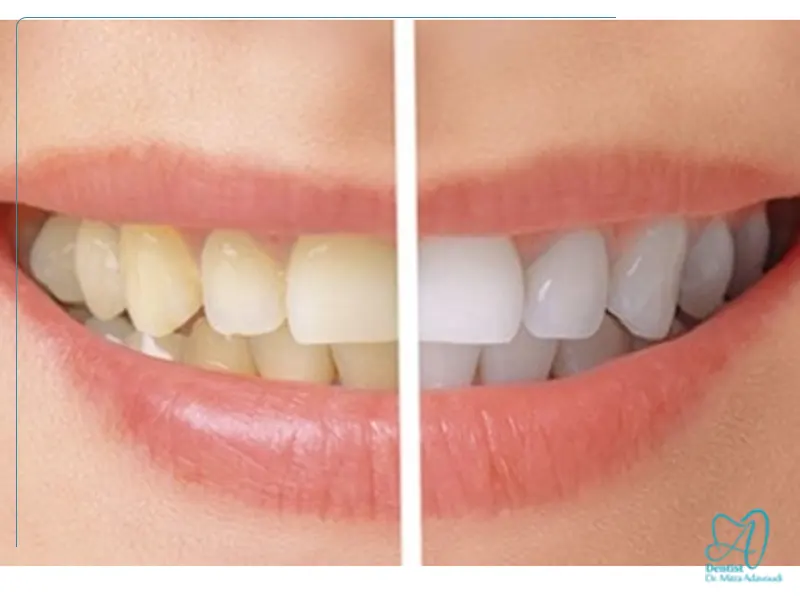 اثرات بلیچینگ روی حساسیت دندان