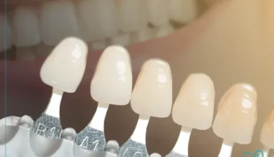 انتخاب رنگ در لمینت و کامپوزیت دندان