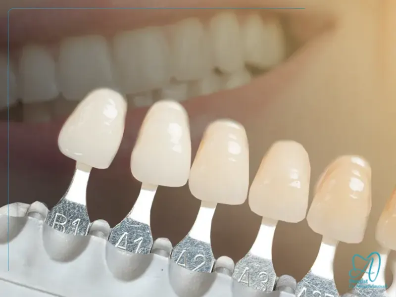 انتخاب رنگ در لمینت و کامپوزیت دندان