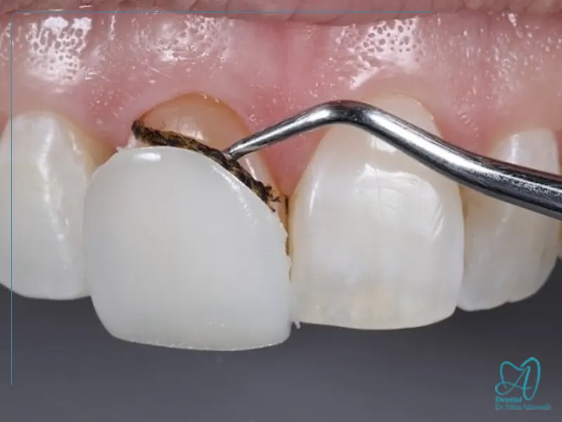 ترمیم کامپوزیت دندان پس از آسیب