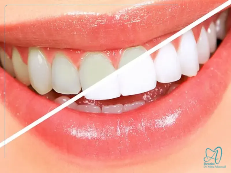 تفاوت بلیچینگ حرفه‌ای و محصولات خانگی