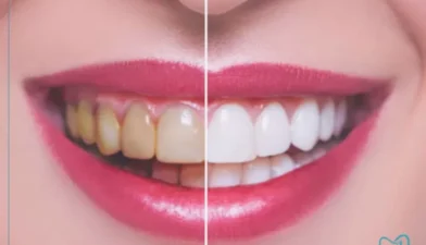 فرق لمینت سرامیکی با کامپوزیت لمینت