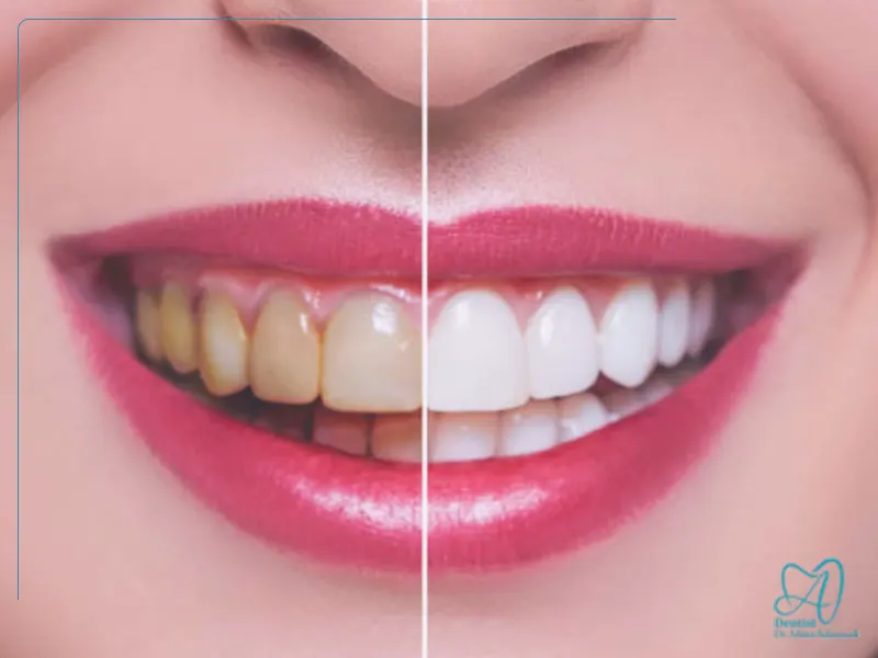 فرق لمینت سرامیکی با کامپوزیت لمینت