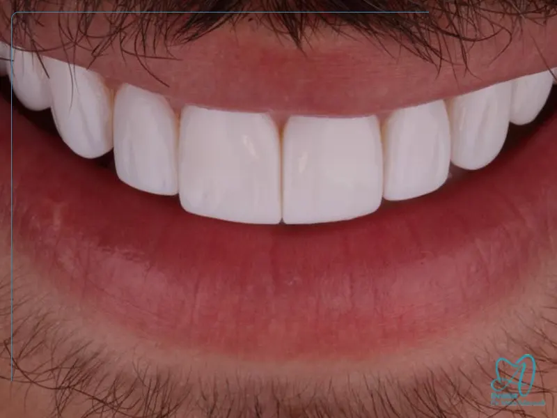 لمینت برای اصلاح شکل نامنظم دندان‌ها