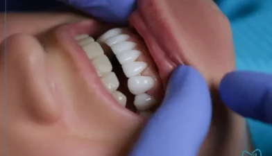 مراقبت بعد از کامپوزیت دندان