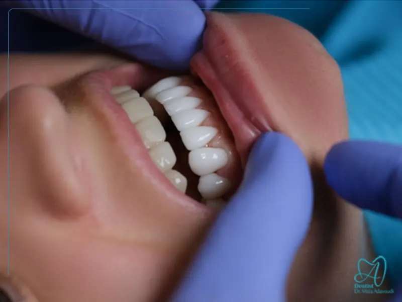 مراقبت بعد از کامپوزیت دندان