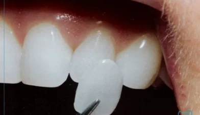 مزایا و معایب لمینت دندان