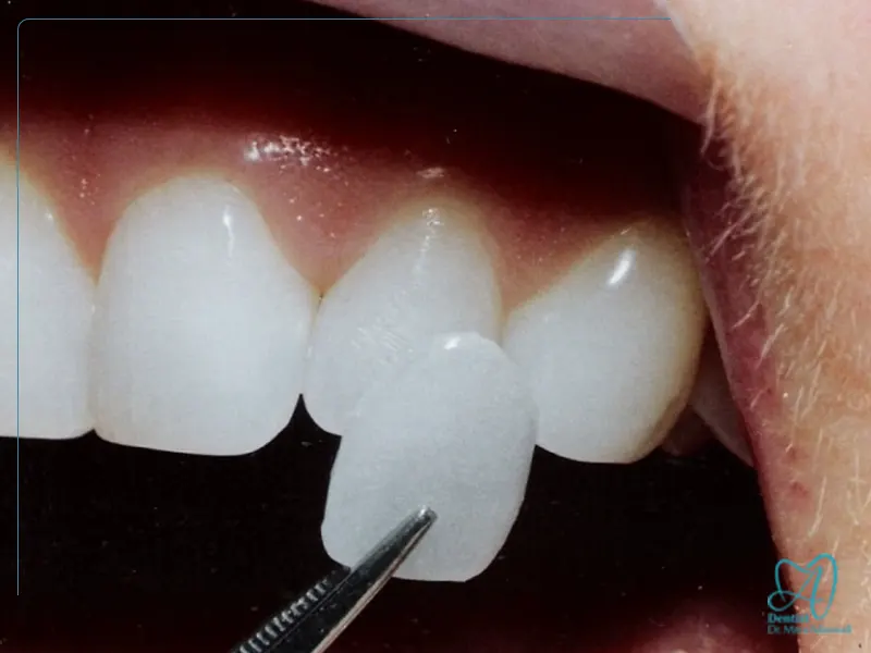 مزایا و معایب لمینت دندان