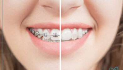 بلیچینگ دندان بعد از ارتودنسی