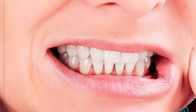 لمینت دندان برای کسانی که دندان قروچه دارند