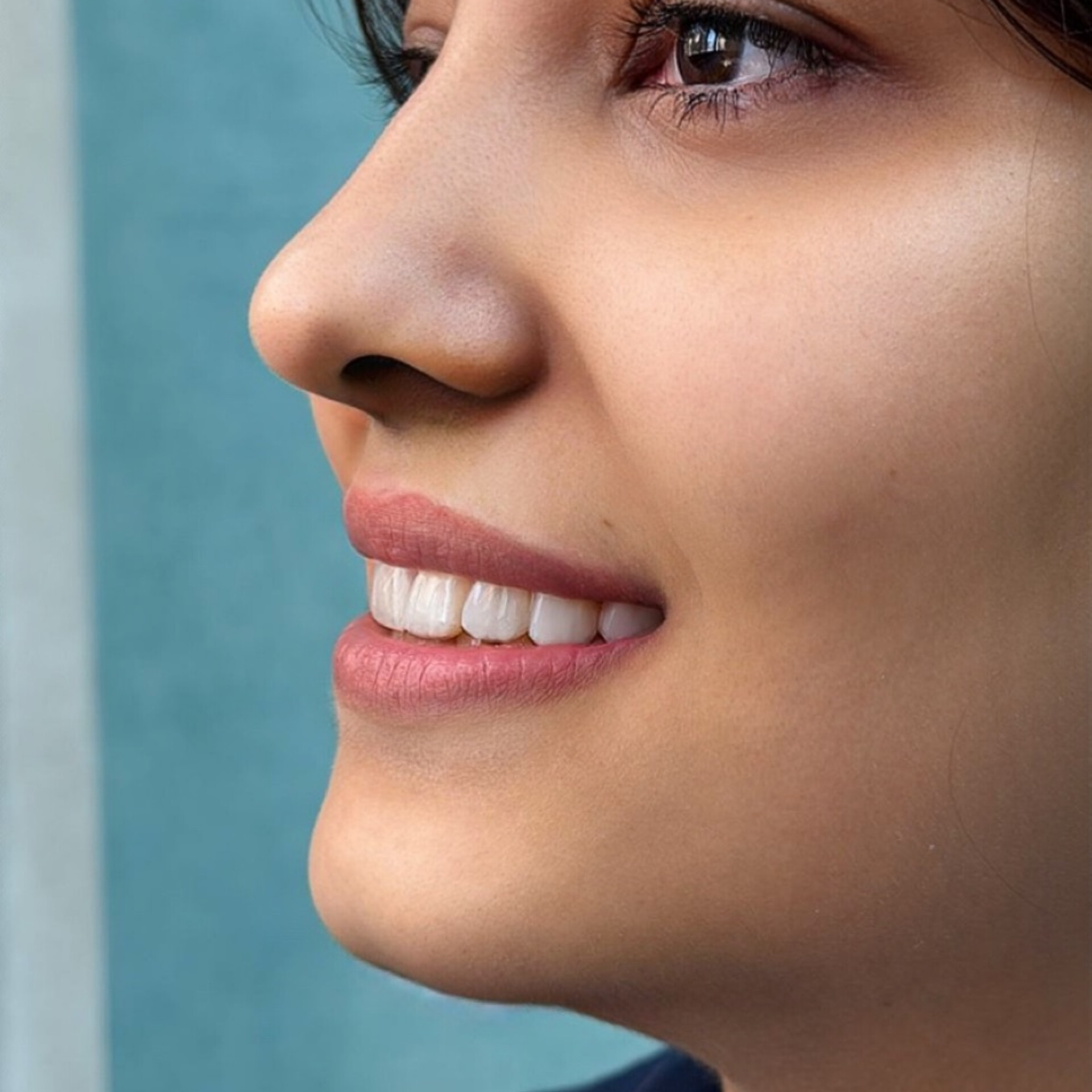 نمونه کار دندانپزشکی دکتر میترا آداودی دندانپزشک اصفهان سه راه سیمین